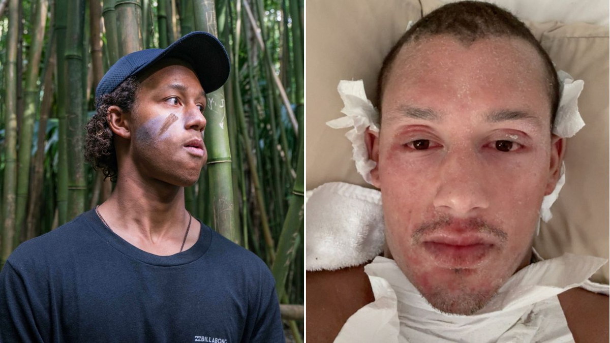 Ostrzeżenie mężczyzny z Perth dla osób cierpiących na egzemę, ponieważ miejscowe odstawienie sterydów sprawia, że jest „nie do poznania”