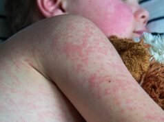 Wielka Brytania traci status eliminacji odry, ostrzega WHO | Wiadomości z Wielkiej Brytanii