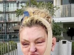 Danniella Westbrook w dalszym ciągu prezentuje wyniki operacji rekonstrukcji twarzy, podczas gdy zabandażowana i posiniaczona gwiazda kąpie się w Dubaju