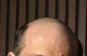 W wieku 24 lat łysiełam i nie mogłam znieść tego wstydu. Potem odkryłam terapię, która działa „w 100% przypadków” i odmieniła moje życie