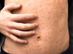 Wielka epidemia odry dotykająca londyńskie dzieci poniżej 10 roku życia