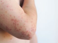 „Potencjalnie śmiertelna” choroba rozprzestrzenia się w Wielkiej Brytanii i Europie – 26 gorących punktów o nazwie | Wielka Brytania | Aktualności