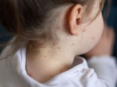 5 rzeczy, które warto wiedzieć w związku ze wzrostem liczby przypadków odry w Londynie | Wielka Brytania | Aktualności