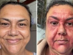 Ekstremalne warunki pogodowe powodują wzrost liczby poważnych chorób skóry – ostrzega specjalista