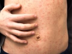 „Szybko rozprzestrzeniająca się” epidemia odry w północnym Londynie powoduje zakażenie ponad 60 dzieci | Wiadomości z Wielkiej Brytanii