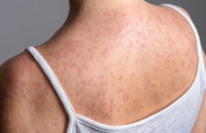 Liczba przypadków odry w Anglii stale rośnie – i to właśnie tam epidemia może się rozprzestrzenić w następnej kolejności | Wiadomości z Wielkiej Brytanii