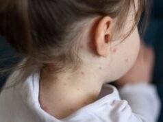 Jakie są objawy odry i co należy zrobić, jeśli podejrzewasz, że Twoje dziecko jest zakażone? | Wiadomości z Wielkiej Brytanii